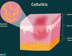 Image result for Cellulitis Belly Button