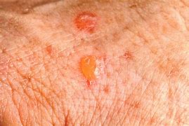 Image result for Wart Skin Lesion
