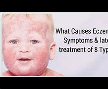 Image result for What Causes Eczema