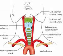 Image result for Internal Carotid Artery