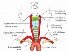 Image result for Common Carotid Artery Blockage