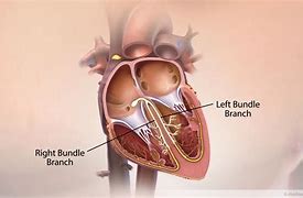 Image result for Bundle Branch Heart