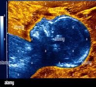 Image result for Fetal Anencephaly