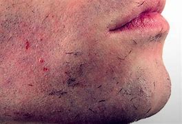 Image result for Ingrown Hair On Face