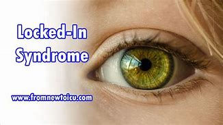 Image result for Locked in Syndrome Stroke