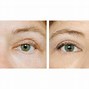 Image result for Verruca Eyelid