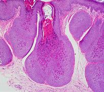 Image result for Molluscum Pregnancy