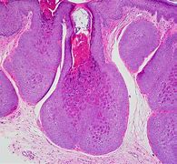 Image result for Molluscum Contagiosum Histology