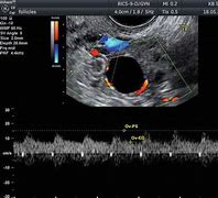 Image result for Normal Ovary MRI