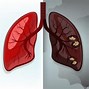 Image result for Lung Cancer Medicine