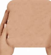 Image result for Skin Cancer Simulation GIF