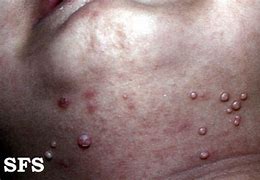 Image result for Molluscum Contagiosum On Black and African American Skin