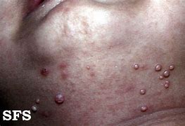 Image result for Molluscum Contagiosum as an STD