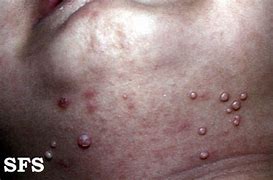 Image result for Infected Molluscum Contagiosum Virus
