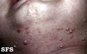 Image result for Molluscum Warts Treatment