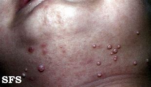 Image result for Molluscum Blisters After Treatment