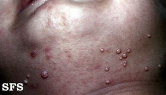 Image result for Molluscum Contagiosum Virus in Ethiopia