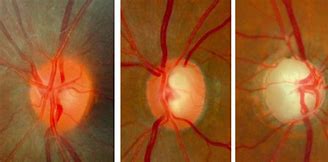 Image result for Optic Disc Cupping Glaucoma