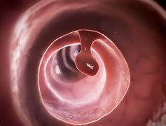 Image result for Small Colon Polyp