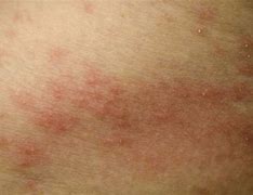 Image result for Gonorrhea Skin Lesions
