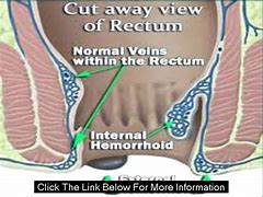 Image result for hemorroids