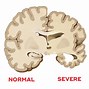 Image result for Normal Shrinking of the Brain