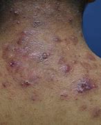 Image result for Lotus Seed Pod Skin Disease