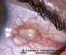 Image result for Bulbar Conjunctival Lymph Cyst