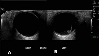 Image result for Retinal Detachment Us