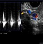 Image result for Anechoic Perimetrium On Ultrasound