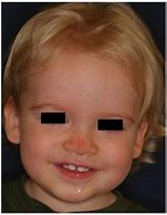 Image result for Nasal Glioma