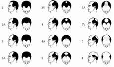 Diagnosing Men S Hair Loss Norwood Scale Chart
