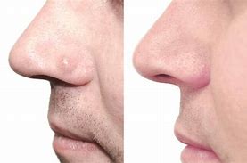 Image result for Nose Mole Removal