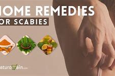 Image result for Scabies Home Remedies