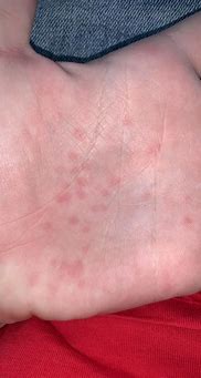 Image result for Bumpy Itchy Rash On Hands