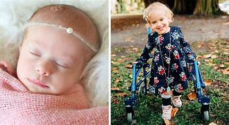 Image result for Child with Spina Bifida