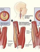 Image result for Bilateral Carotid Artery Stenting