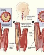 Image result for Carotid Artery Stenting