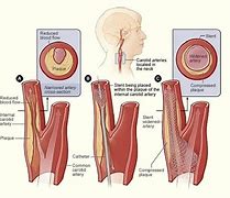 Image result for Transfemoral Carotid Artery Stenting