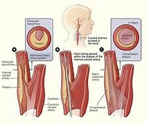 Image result for Carotid Artery Stenosis Image