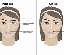 Image result for Peripheral Facial Nerve Palsy