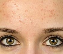 Image result for Small Acne Bumps On Face