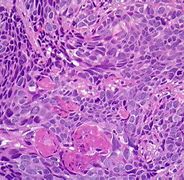 Image result for Papilloma Scalp