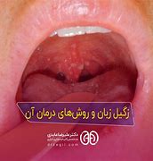 Image result for Tongue Warts