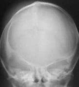 Image result for Craniosynostosis X-ray