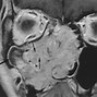 Image result for Papilloma On Foot