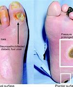 Image result for Diabetic Sores On Gentals