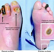 Image result for Diabetic Foot Sores