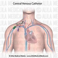 Image result for Anterior Central Venous Catheter