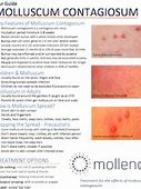 Image result for Best Treatment for Molluscum